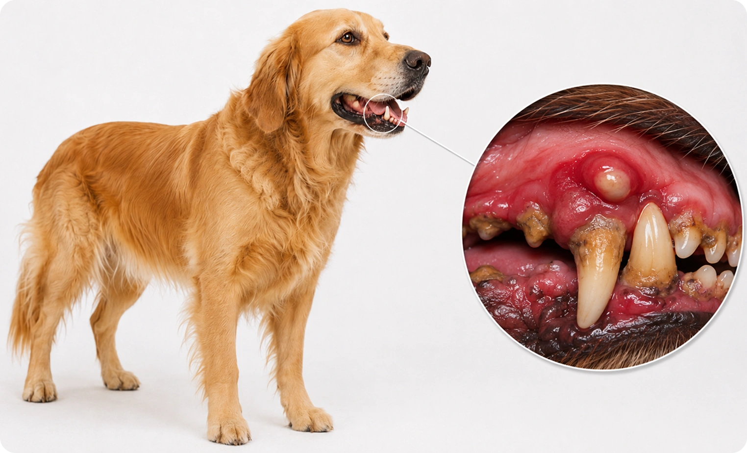 Gingivitis
