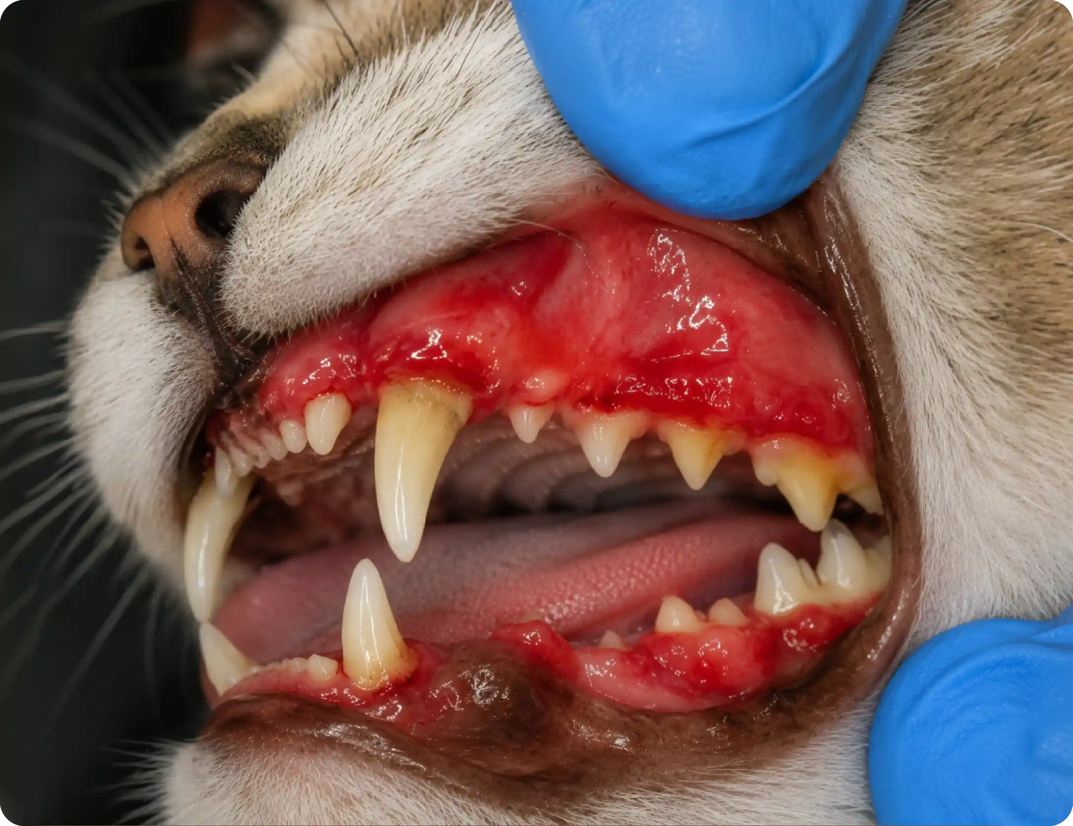 Gingivitis